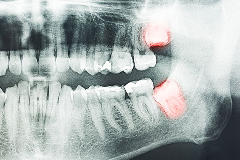 GCOFS Wisdom Tooth X-ray